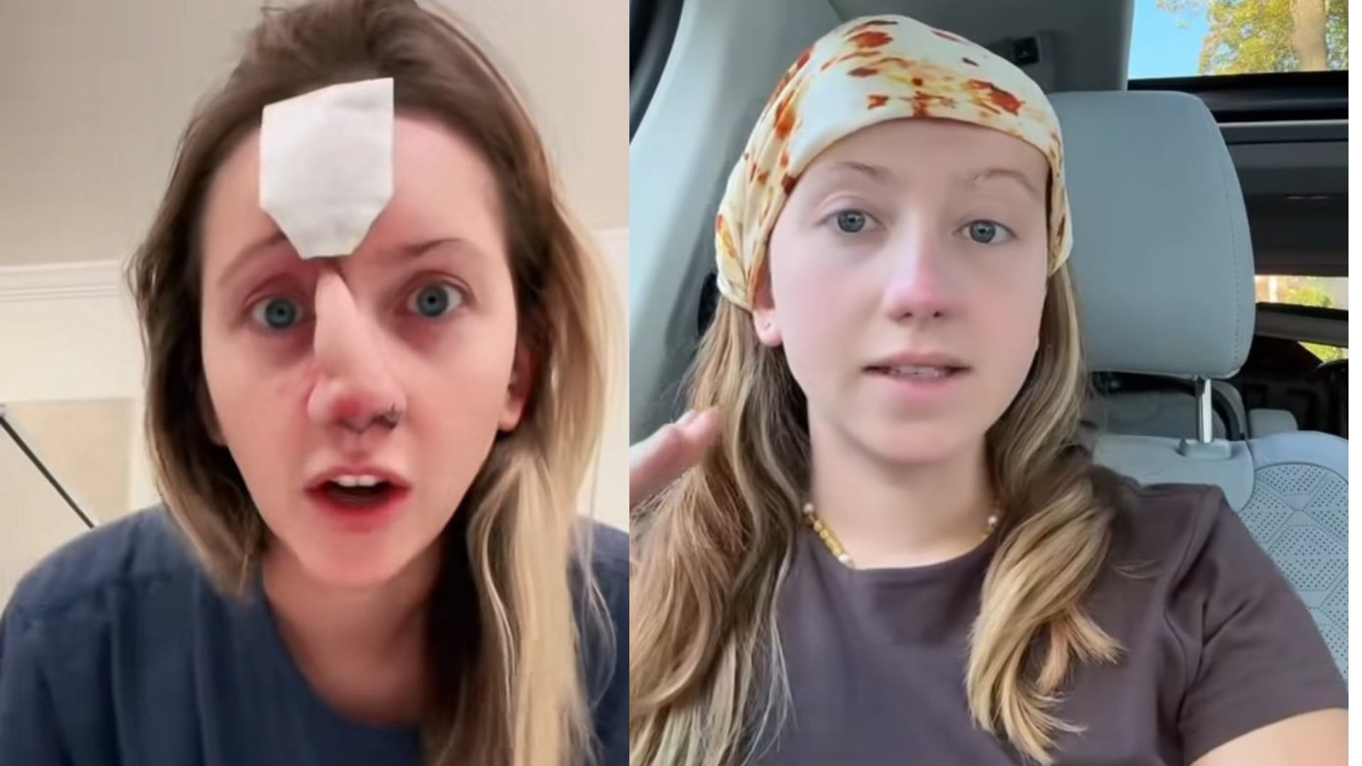 Mulher que teve o nariz mordido por cachorro e passou por 16 cirurgias mostra o antes e depois – Noticias R7